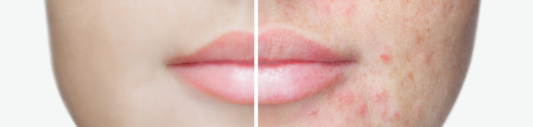 Skin with and without acne